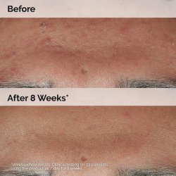 سرم ضد جوش Niacinamide 10% + Zinc 1% اوردینری حجم 30 میلی لیتر